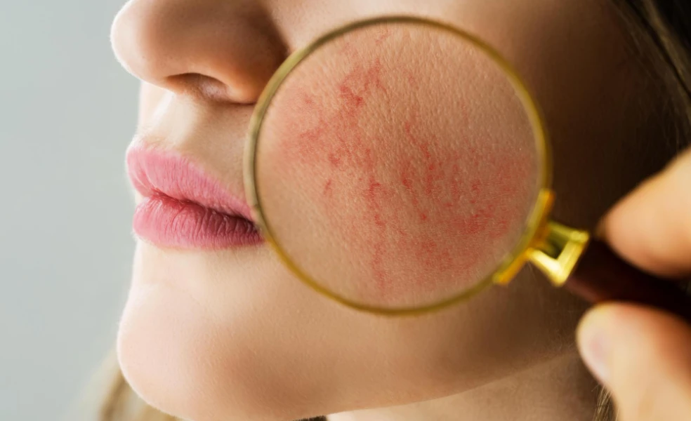 rosacea