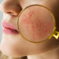 Rosacea: Čo ju spôsobuje a ako ju udržať pod kontrolou?