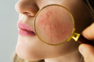 Rosacea: Čo ju spôsobuje a ako ju udržať pod kontrolou?