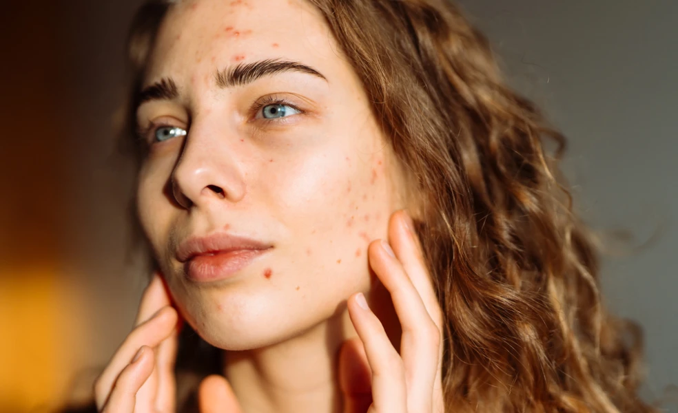 príčiny akné podľa miesta výskytu