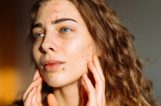 Akné podľa zón tváre: Čo sa ti snažia naznačiť vyrážky na rôznych miestach?