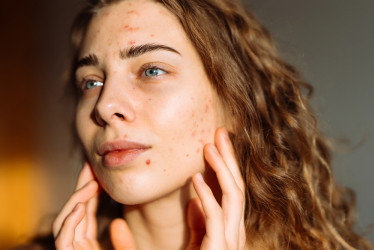 Akné podľa zón tváre: Čo sa ti snažia naznačiť vyrážky na rôznych miestach?