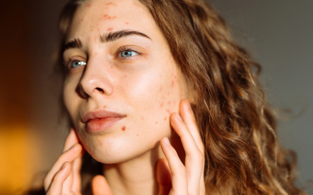 príčiny akné podľa miesta výskytu