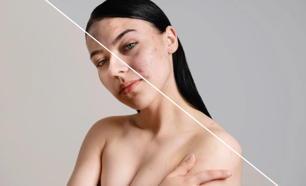 mikrodávkovanie Accutane