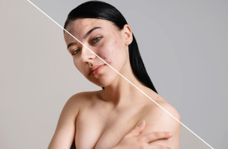 Hollywoodsky trik dermatológov: Prečo si hviezdy dávkujú Accutane ako vitamíny?