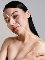 Hollywoodsky trik dermatológov: Prečo si hviezdy dávkujú Accutane ako vitamíny?