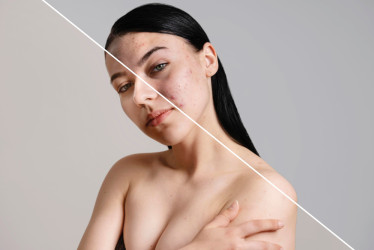 Hollywoodsky trik dermatológov: Prečo si hviezdy dávkujú Accutane ako vitamíny?