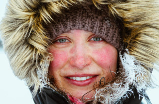 Rosacea liečba v zime: Súboj, ktorý trápi státisíce ľudí so svetlou pleťou