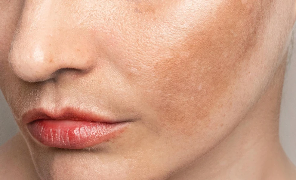 príčiny pigmentácie