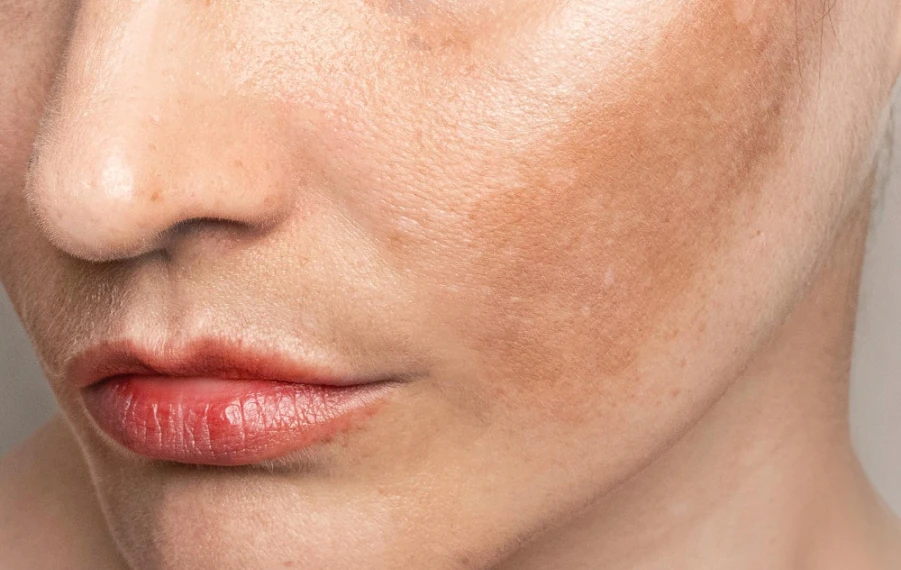 príčiny pigmentácie