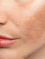 Prečo sa pigmentové škvrny vracajú, aj keď robíte všetko správne? Toto vám nikto nepovedal