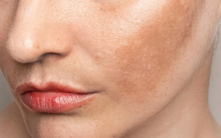 príčiny pigmentácie